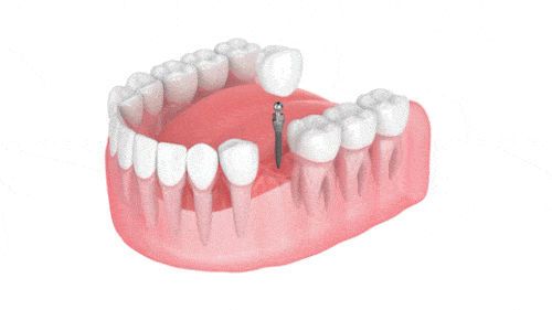 Single Tooth Replacement with Mini Dental Implant