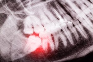 Extractions in Colorado Springs, CO Tooth Extraction Dentist