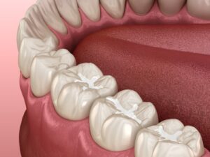 Fillings in Colorado Springs, CO Composite Tooth-Colored Fillings
