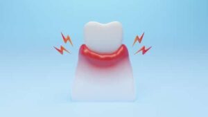 Gum Disease Treatment in Colorado Springs Best Care Dental
