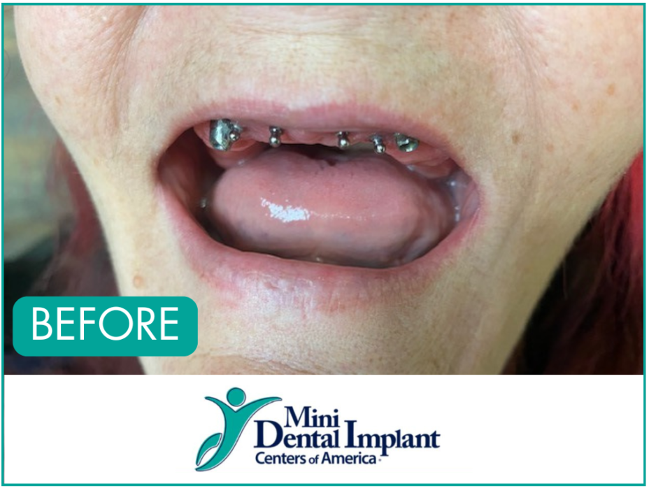 Best-Care-Dental-Implant-Dentures-Before