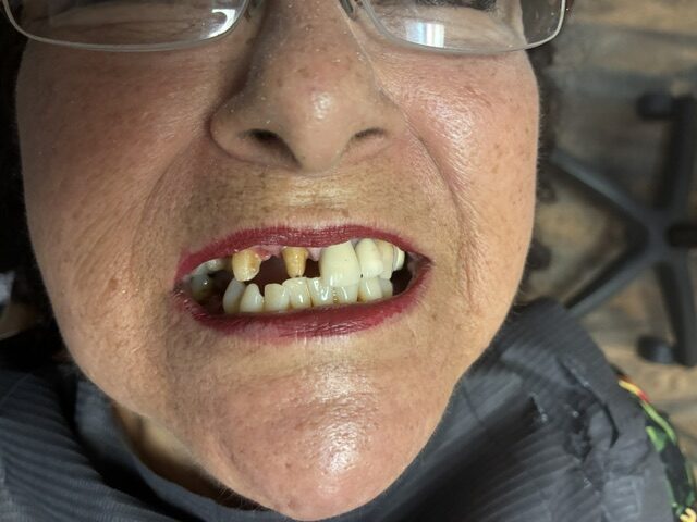 Dental implant before and after example
