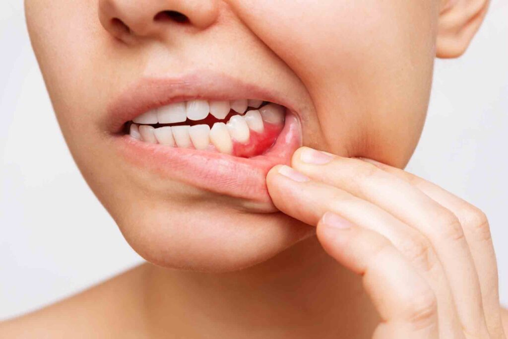 gum