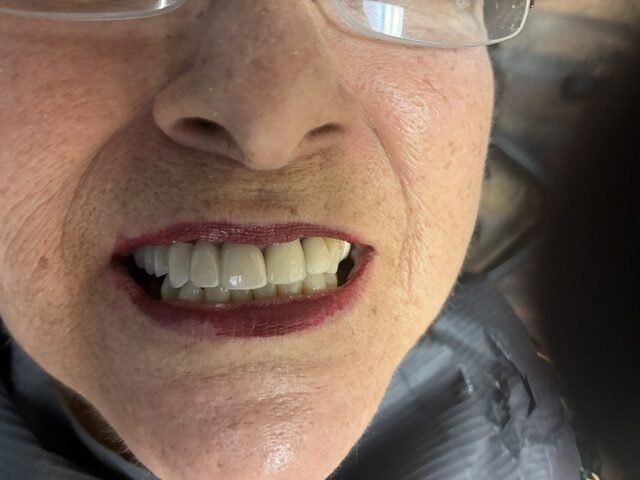 dental-imaplants-after