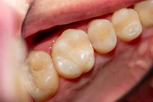 filling-after