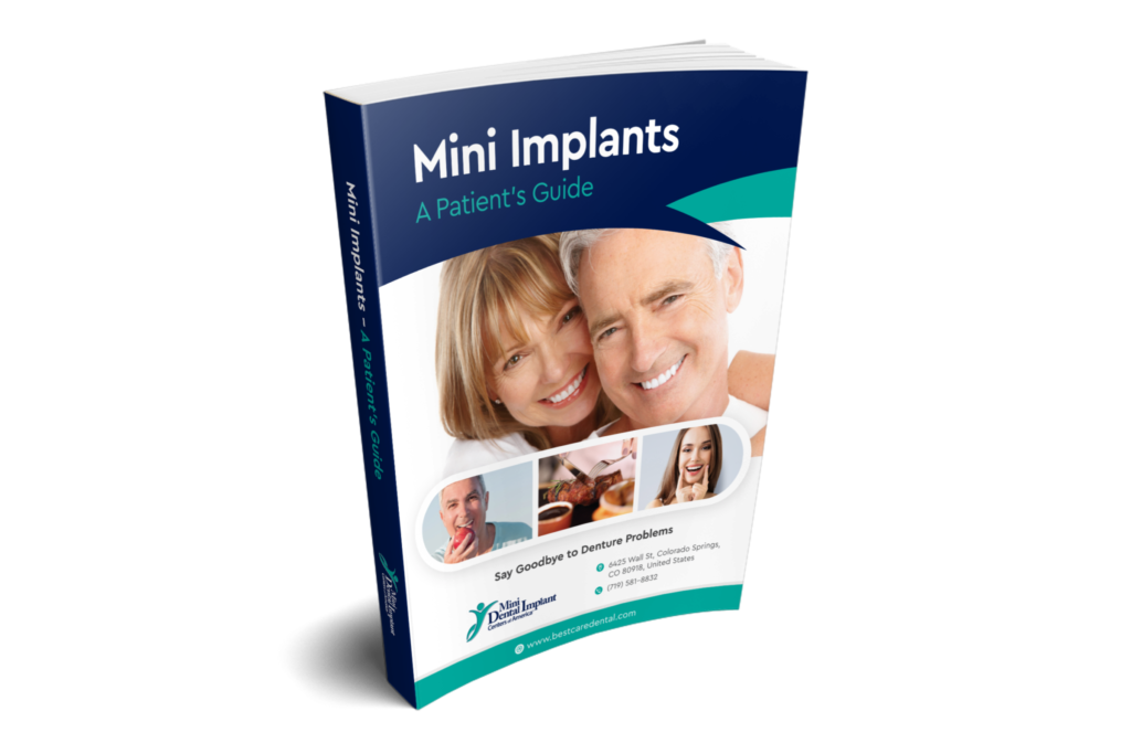 Mini-Implant