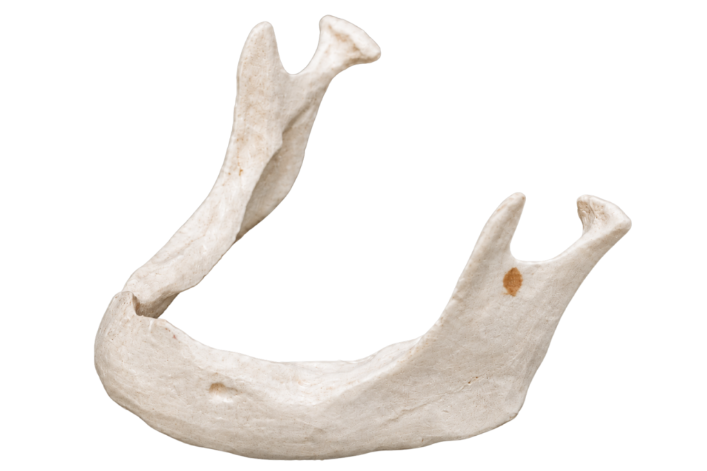 Bone Loss Stage 3