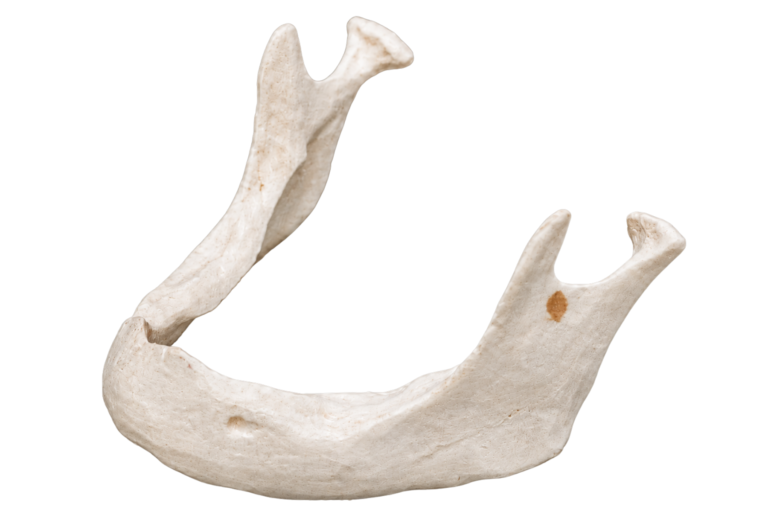 Bone Loss Stage 3