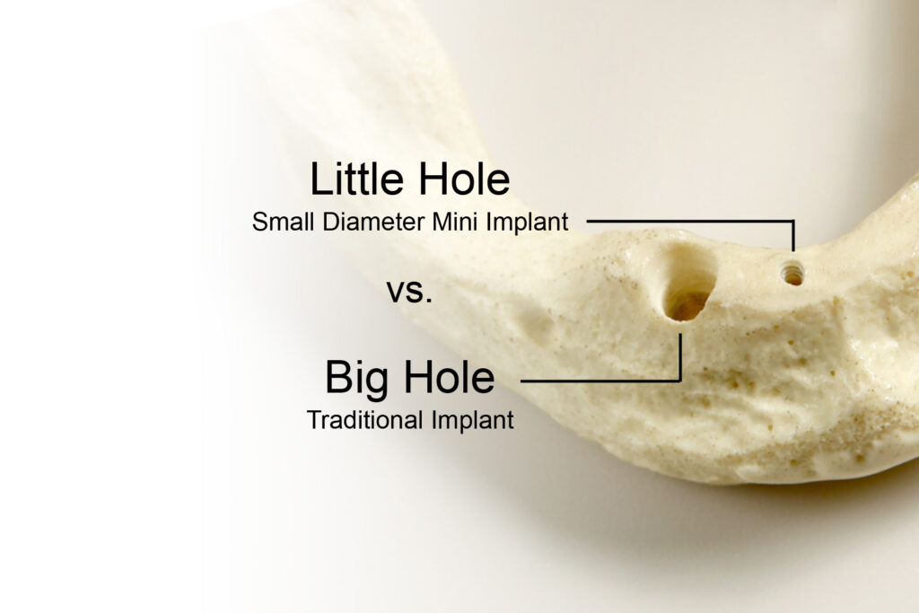 Comparison of osteotomy drilling with conventional dental implants vs mini dental implants