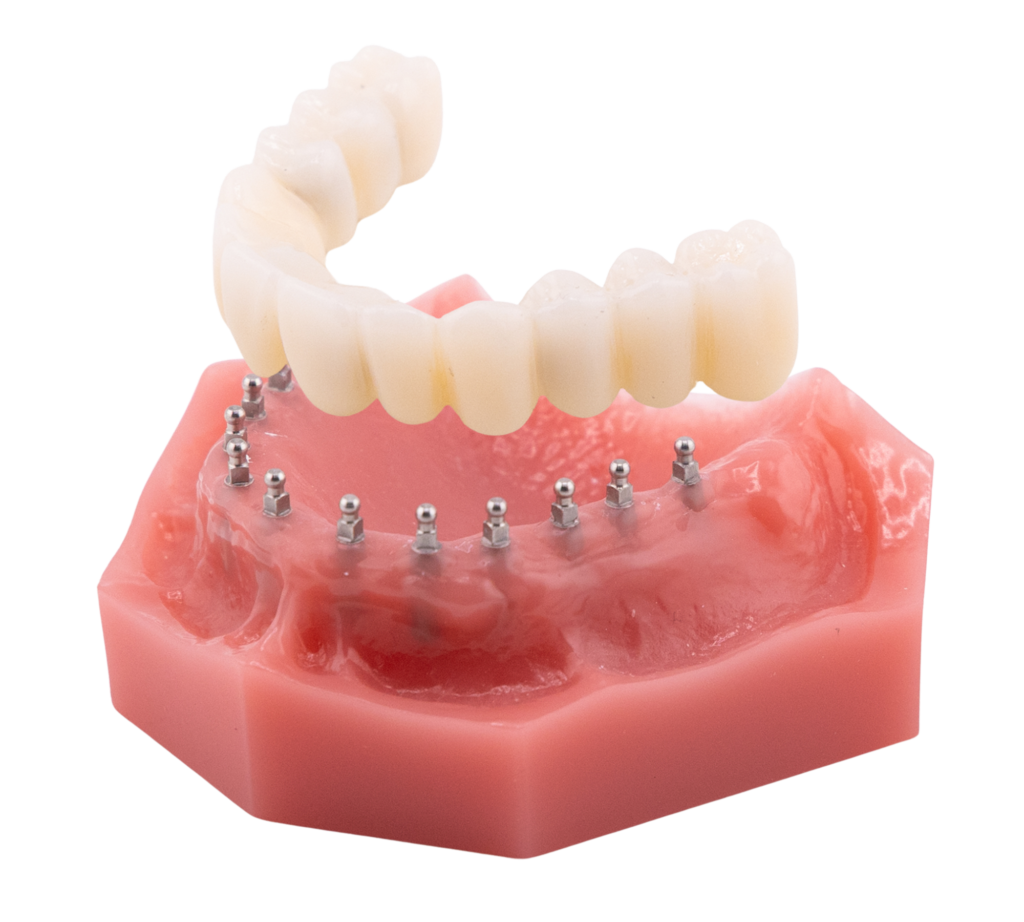 Fixed Bridge - Permanent Mini Implant Bridge