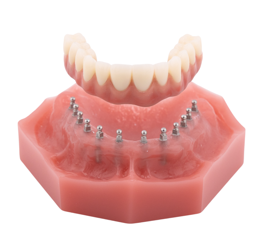 Fixed Bridge - Permanent Mini Implant Bridge with Gingiva