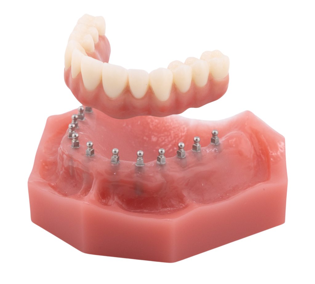 Fixed Mini Implant Bridge - Permanent Zirconia Bridge with Gingiva