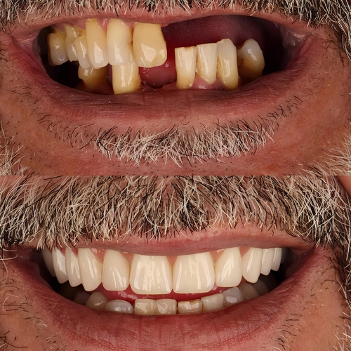 Full-mouth restoration with traditional dental implants