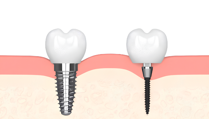 Mini DEntal Implants vs Traditional Dental Implants Comparison