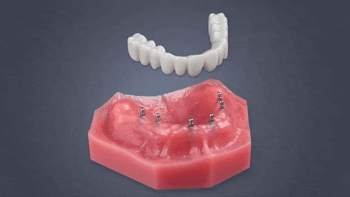 Mini Dental Implant Bridge - Full Arch Dental Implants
