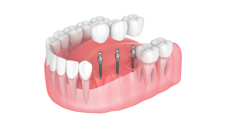 Mini Dental Implant Bridge - Replacing Multiple Teeth