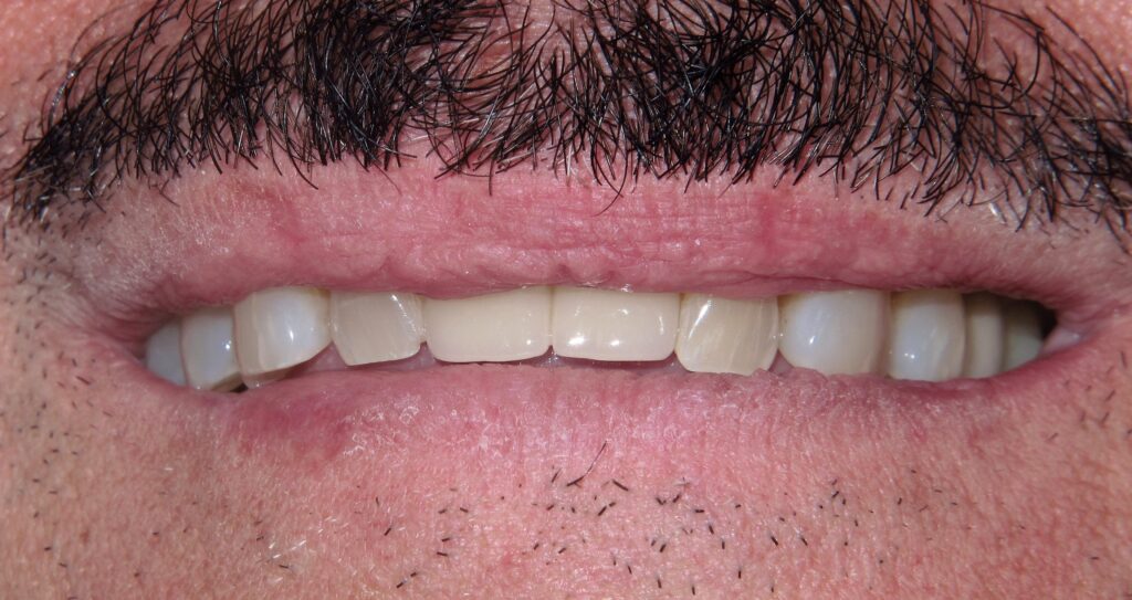 Mini Implant Patient 1 - After