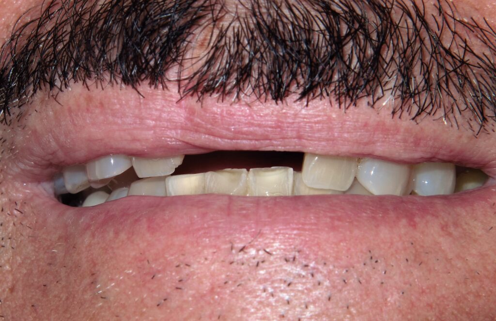 Mini Implant Patient 1 - Before