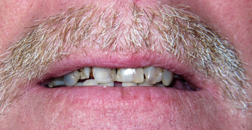 Mini Implant Patient 2 - Before