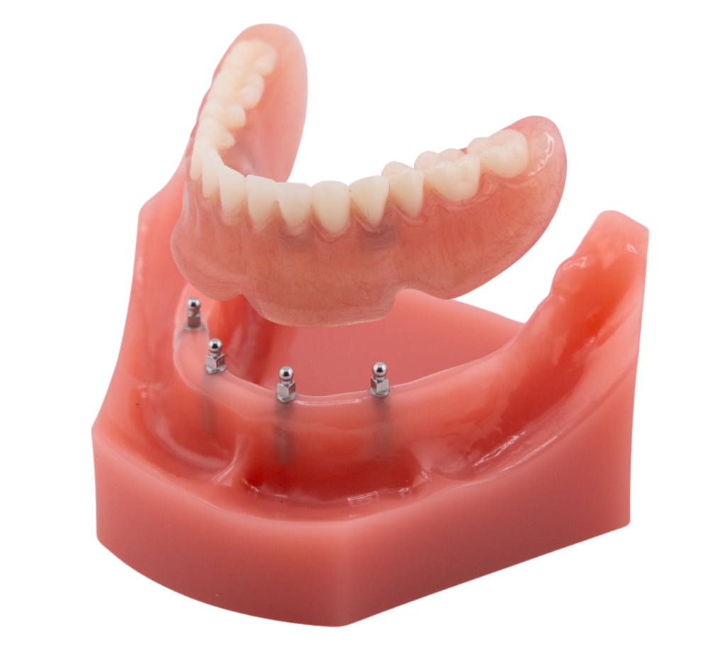 Snap-In Mini Implant Denture