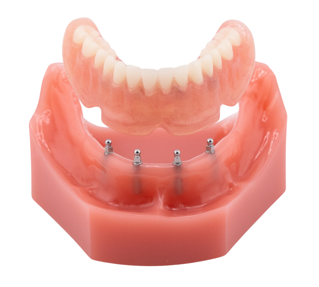 Snap-On Implant Denture